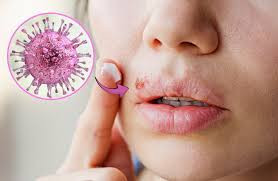 Herpes tam sağalırmı? – Həkimdən vacib açıqlama&nbsp;&nbsp;