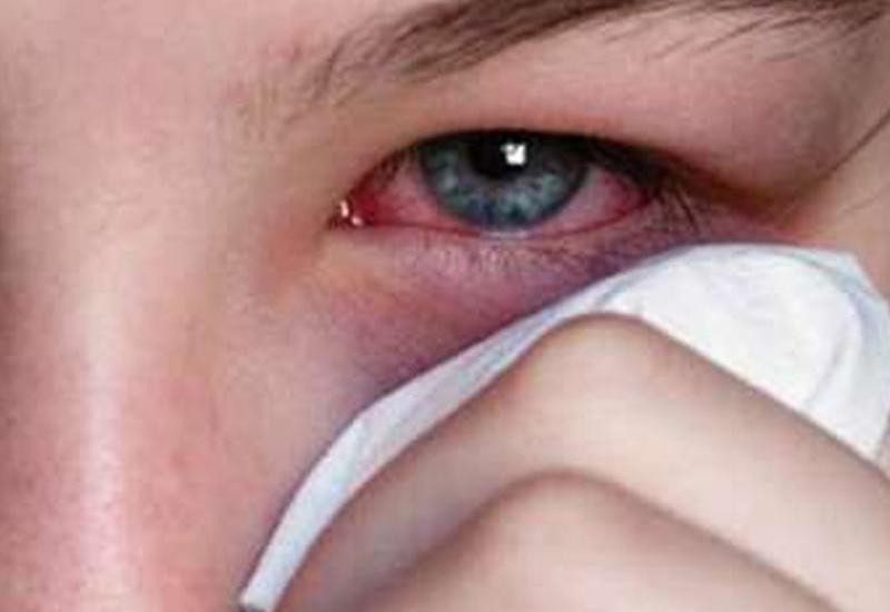 Göz allergiyası tam müalicə olunurmu? – Həkimdən vacib AÇIQLAMA&nbsp;&nbsp;