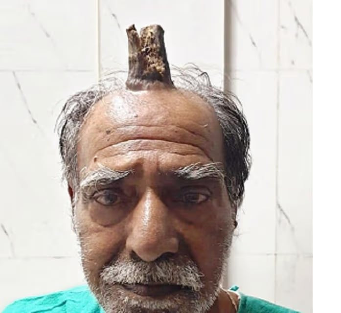 74 yaşlı kişinin başında “buynuz\" çıxdı - FOTO&nbsp;&nbsp;