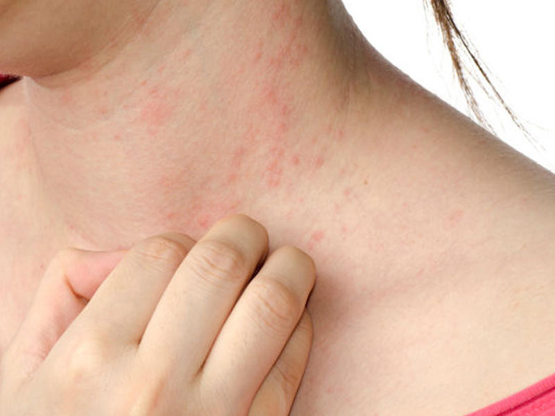 Allergiyanı birdəfəlik müalicə etmək mümkündür? – Həkim açıqladı