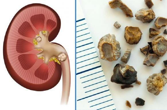 Uroloq AÇIQLADI: Ağrı verməyən daş ciddi riskdir