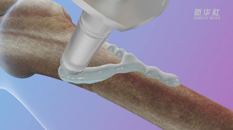 Təbabətdə İNQİLAB: Elm adamları sınıq sümükləri bərpa edən tibbi yapışdırıcı icad etdilər&nbsp;&nbsp;