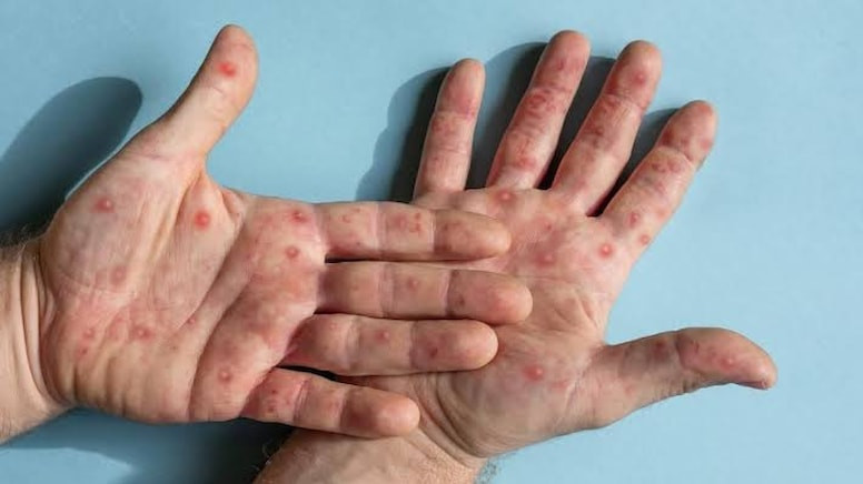 Kabus geri döndü: Epidemiya 3 ölkəyə yayıldı