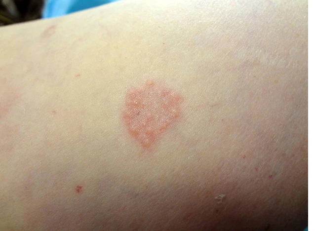 Qranuloma Anulare nədir ?&nbsp;&nbsp;