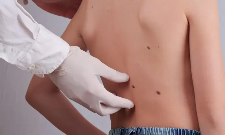 Dəridəki xallara toxunmaq təhlükəlidirmi? – Dermatoloqdan XƏBƏRDARLIQ