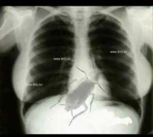 Azərbaycanlı həkim xəstəyə "sinəndə böcək var" deyib xaricə göndərdi, BİABIR OLDU - FOTOFAKT