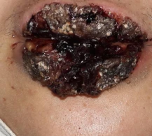 Əsəbi zəif olanlar baxmasın!Əməliyyatdan sonra dodağı çürüdü