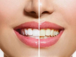 Dişləri ağartmır, çürüdür - DOĞRU BİLİNƏN YANLIŞ