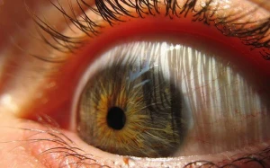 Gözünüzün ağında ləkə varsa TƏCİLİ HƏKİMƏ GEDİN - Kor ola bilərsiniz