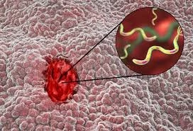 Mədə xərçəngini yalnız bir bakteriya yaradır