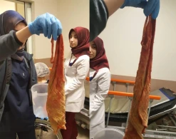 Xəstənin qarnından görün nə çıxdı - ŞOK VİDEO