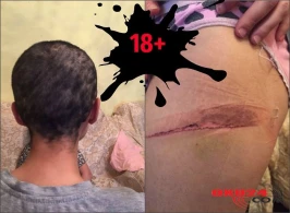 Saçı qırxılan qadına verilən işgəncə izlərinin ŞOK görüntüləri yayıldı (Fotolar, +18)