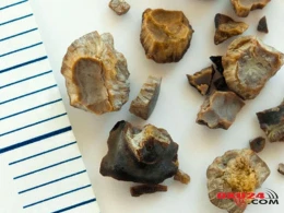 Böyrək və öd kisəsi daşlarından təbii yolla azad olun - Qəpik-quruşluq reseptlər