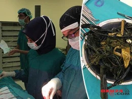 Uşağın mədəsindən çıxanlar həkimləri ŞOKA SALDI