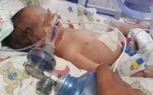 Azərbaycanda  3 günlük körpənin bağırsağı deşildi, 10 sm-lik cürümüş hissə kəsildi –( VİDEO 18+)