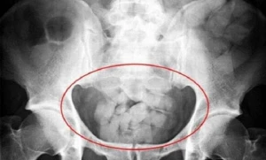 Azərbaycanda ŞOK olay: Gömrük işçiləri qadının cinsiyyət orqanından briliant çıxardı