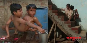 Bədənləri birləşik,başları ayrı: Siyam əkizləri necə doğulur?+VİDEO