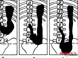 Mədə sallanması nədir, əlamətləri – Mədəni yerinə necə çəkməli?
