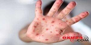 Azərbaycanda qızılcaya yoluxma qeydə alınıb: Xəstəliyin Gürcüstandan keçdiyi ehtimal edilir