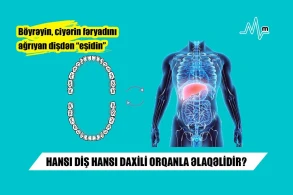 HANSI DİŞ HANSI DAXİLİ ORQANLA ƏLAQƏLİDİR? - Böyrəyin, ciyərin fəryadını ağrıyan dişdən “eşidin”