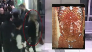 Hava limanında ŞOK olay: Qadının mədəsindən 115 ədəd prezervativ çıxdı