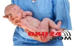 Gürcüstanda 716 nəfər qızılcaya yoluxub