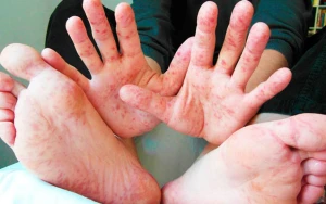 Nazirlikdən qızılca açıqlaması - Əhali peyvəndlənəcək