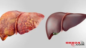 Qaraciyər çatışmazlığına səbəb olan AMİLLƏR