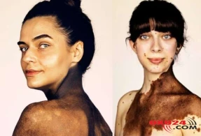 İNANILMAZ: Bu insanlar nadir dəri xəstəliyi ilə dünyaya gəliblər və... - FOTOLAR