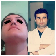 Məşhur estetik cərrah gənc qızın burnunu pis hala saldı- FOTO