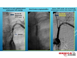 Beyindən qanı oğurlayan damar sindromu - Gözü qaralır, qolu keyləşirdi