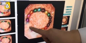 Uşaq muncuqları uddu, mədəsində qolbaq əmələ gəldi