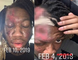 Məşhur  reper  qorxunc   xəstəliyə  tutuldu, öz  ətini  yeyir