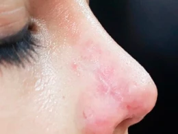 Azərbaycanda qorxunc hadisə: Burnunu düzəltdirmək istəyən qızın başına iş gəldi, çürümə gedir