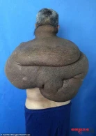 15 kiloqramlıq şiş bütün kürəyinə yayıldı /FOTO