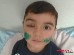 Üzünü it parçalayan uşağın SON DURUMU - FOTO