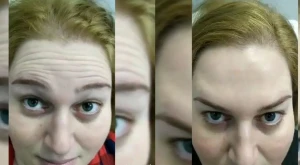 Bakıda kosmetoloqdan inanılmaz nəticə!Qırışları 5 dəqiqədə yox etdi