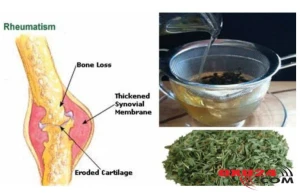 Bu xalq təbabəti vasitəsilə revmatizma birdəfəlik yoxa çıxacaq!