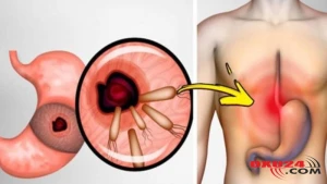 Mədə xərçəngindən qurtulmağın yolu - ŞƏRTLƏR