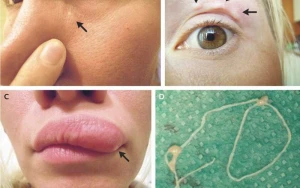 Qəfil ölümlərin səbəbi bu qurdlar imiş – Qadının üzündə yaranan şiş həkimləri dəhşətə gətirdi