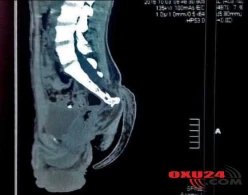 Azərbaycanda 17 yaşlı oğlanda quyruq aşkarlanıb - FOTO