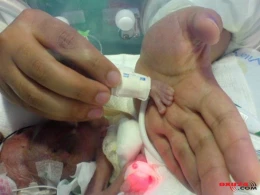 Dünyanın ən balaca körpəsi doğulub – ALMA BOYDADIR - FOTOLAR