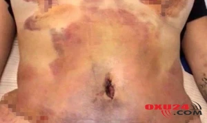 Əməliyyat olunan qadının qarnı çürüyüb – Foto