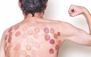 Bu xəstəliklərdə banka qoymaq qadağandır