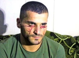 DƏHŞƏT! "Qan ağlayan" adam xəstəliyinə çarə axtarır