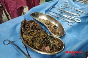 Görün qızın mədəsindən nələr çıxdı- Gözlərinizə inanmayacaqsınız !