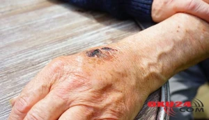 Qarayaradan ilk ölüm: bu xəstəlik nədir və necə yaranır?