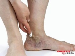 MARAQLI Sizdə tromb olduğunu göstərən 6 əlamət – Ölümün bir addımlığında