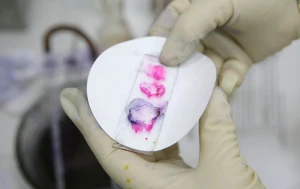 SON DƏQİQƏ! Ermənistanda öldürücü təhlükəli xəstəlik yayıldı