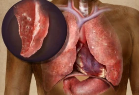 Vərəmin 6 əlaməti – Gecikməyin!